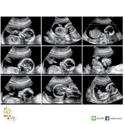 สอบถามเรื่องอัลตร้าซาวด์ค่ะ