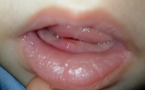 swelling sa gums