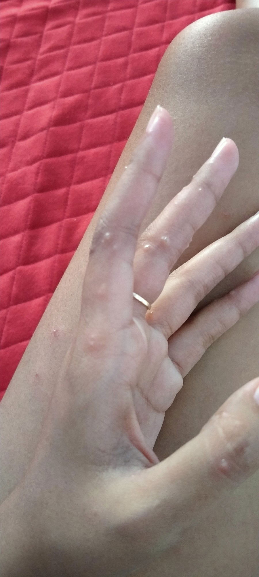 bruntusan saat hamil 26 week