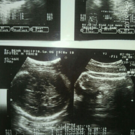 hasil usg