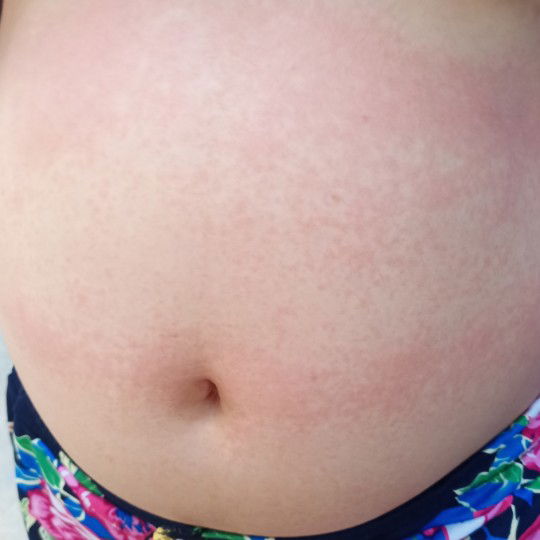 1ST TRIMESTER SKIN RASHES