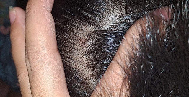 sugat sa ulo ng baby