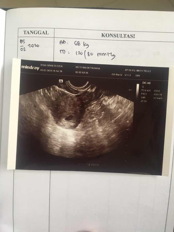 Hamil muda tidak mual & muntah