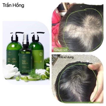 tình trạng rụng tóc