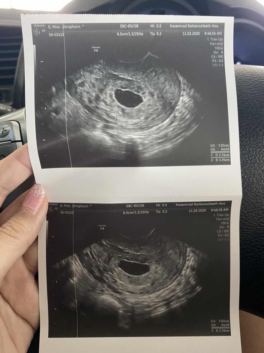 เจอแต่ถุงตั้งครรภ์