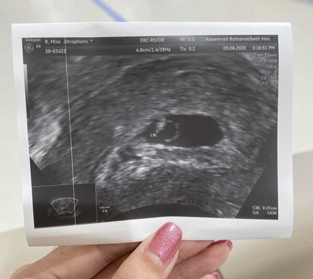 แม่ๆ สอบถามหน่อยคะ เราเป็นแท้งคุกคาม ตอนนี้อายุครรภ์ 6w