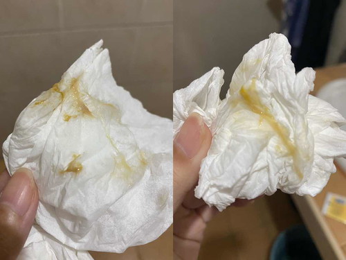 มีตกขาวแบบนี้ออกมา เป็นอะไรมั้ยคะ