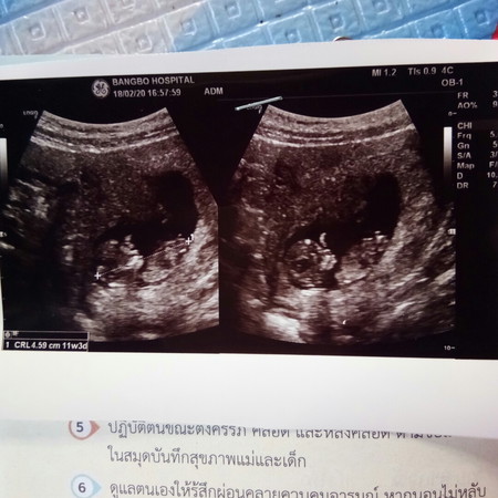 ไทรอยด์