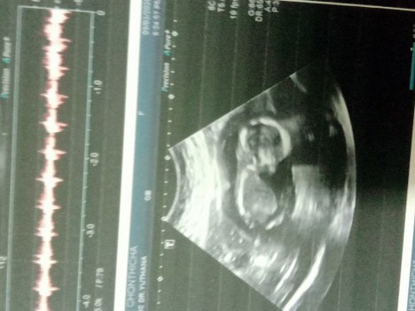 มีแม่คนไหน มีอาการป่วย หรือ ติดเชื้อระหว่างตั้งครรถ์บ้างมั้ยคะ?