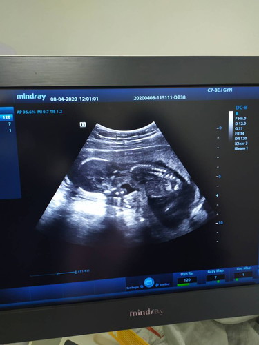 อันนี้ซาวน์ตอน17week