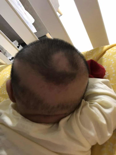 Hair not growing at some part