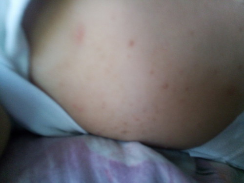 Skin problem