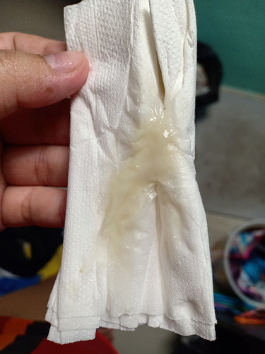 ใช่ตกขาวปกติไหมค่ะ