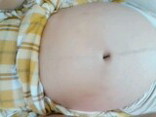 34weekท้องเริ่มเเตกลาย มีเเม่บ้านไหนท้องลายเหมือนเราไหม ทาครีมก้อเอาไม่อยู่