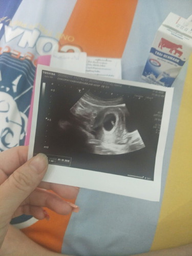 7สัปดาห์ ดิ้นเหมือนกุ้งเต้นเลยน่ะ