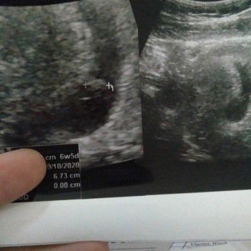 detak jantung blm ada