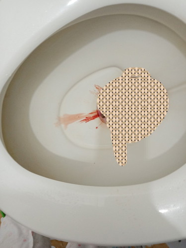 Postpartum Constipation