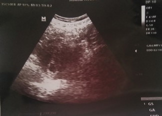 hasil usg 6 week kantong janin tidak bulat