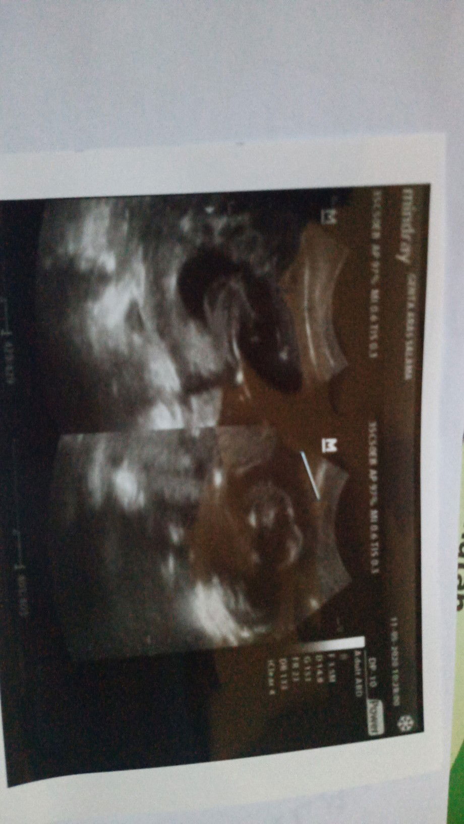 tegang rahim waktu hamil