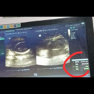 ketuban keruh 25week