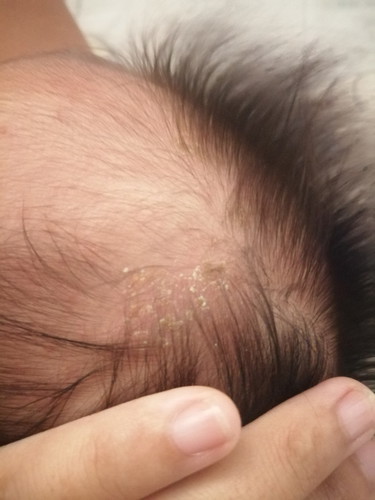 หนังหัวลอกทำยังไงดีค่ะ