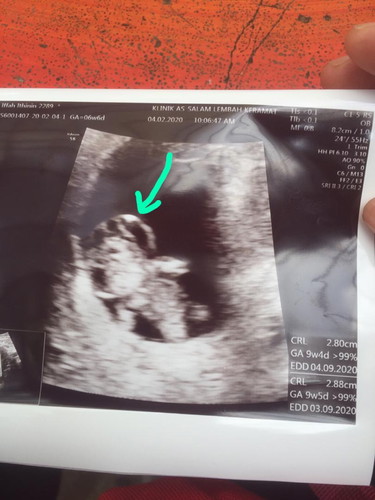 Cystic hygroma..