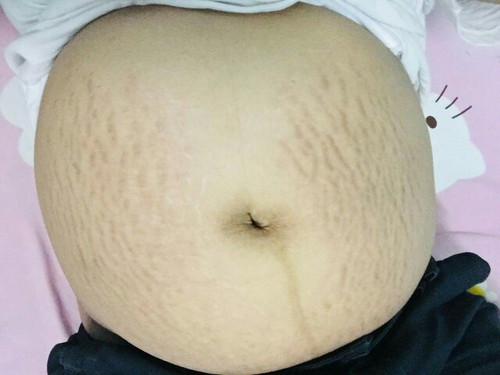 ใช้อะไรช่วยลดแตกลายบ้างค่ะ.