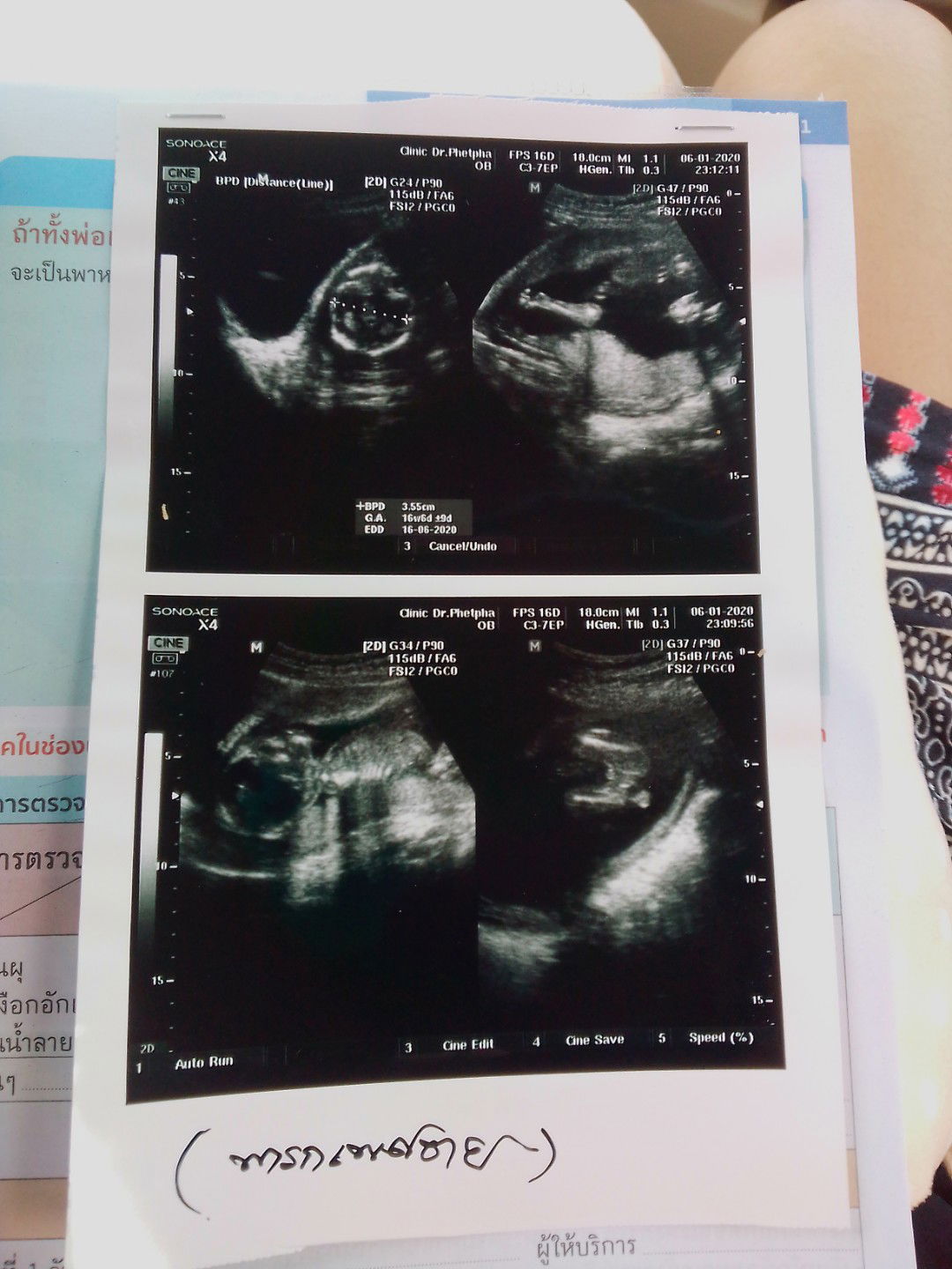 เเพ้ท้องหนัก