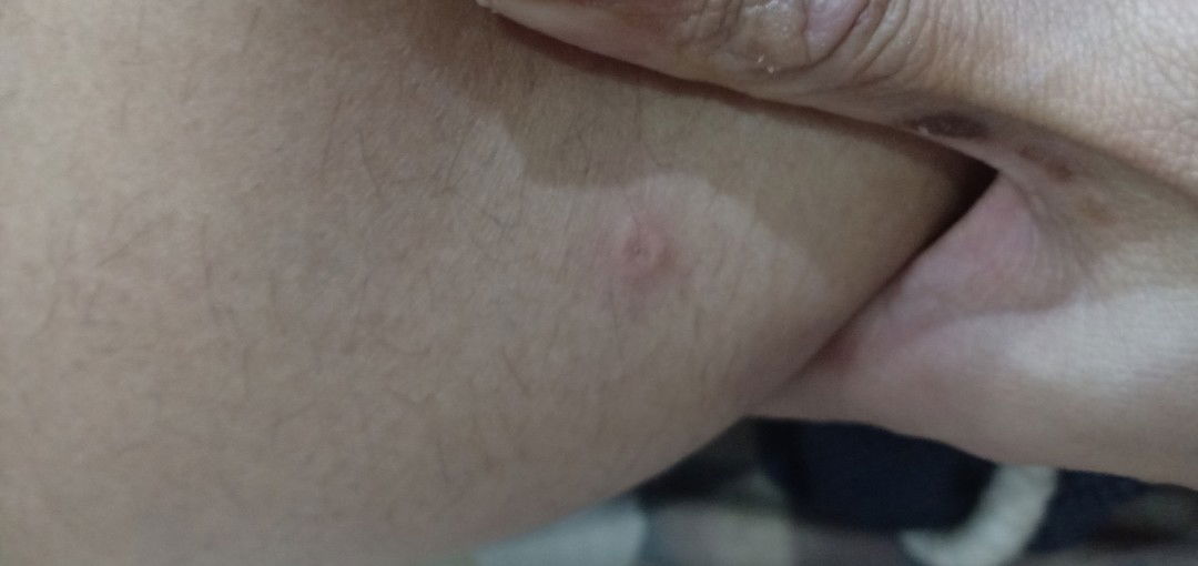 bentol ruam dan gatal saat hamil muda