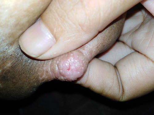 หัวนมฉีก เจ็บมากกกก!! เวลาลูกดูด