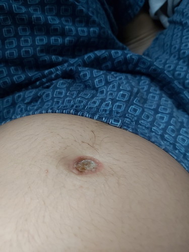 wet and flaking belly button