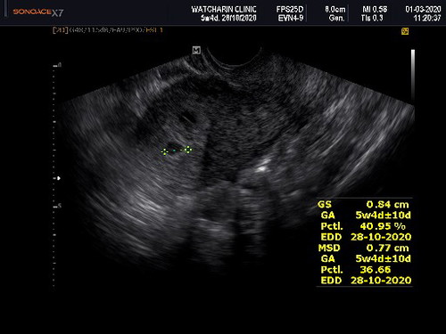 สอบถามเกี่ยวกับท้องนอกมดลูก