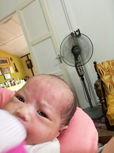 Bintik Merah Dimuka Baby