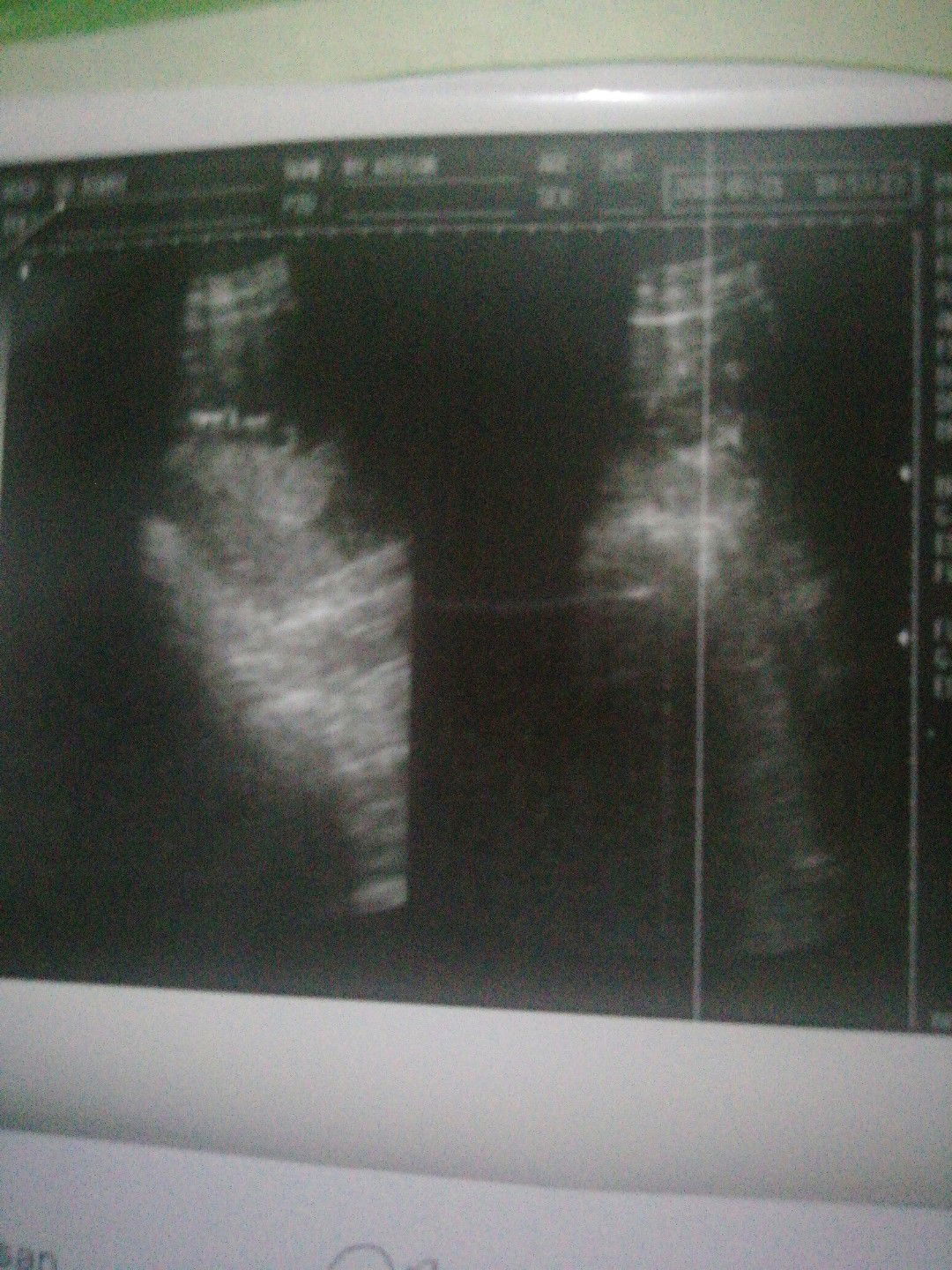 Gak Puas Dengan USG pertamaku?