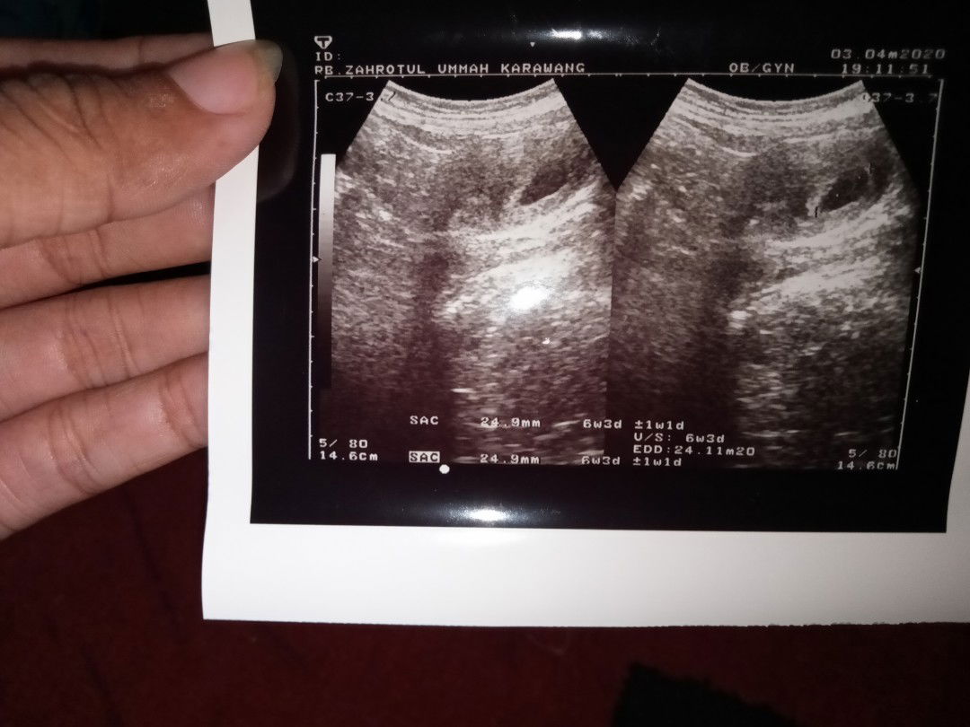 sedih mendengar hasil usg