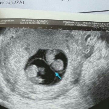 miscarriage