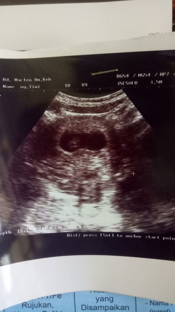 kantung janin