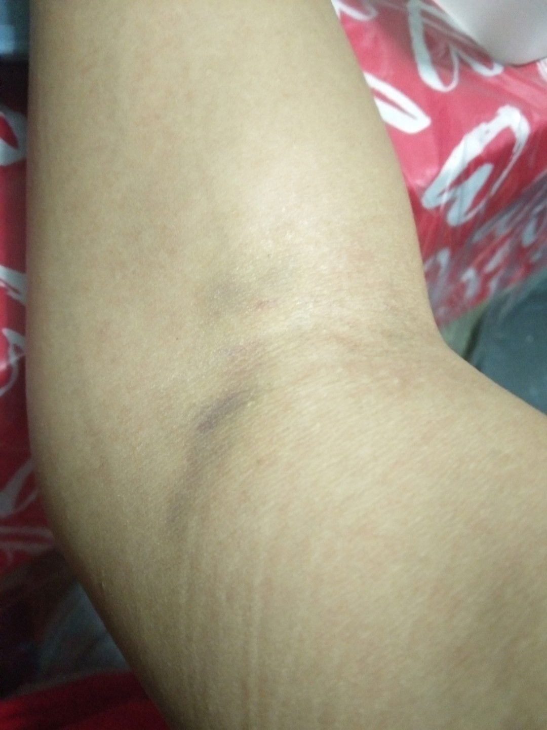 bruise/pasa