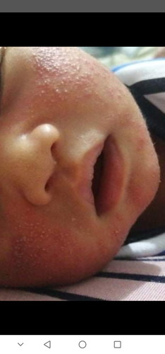 Rashes?