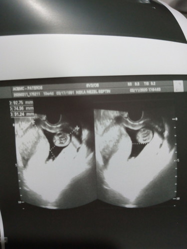 No more Subchorionic Hemorrhage