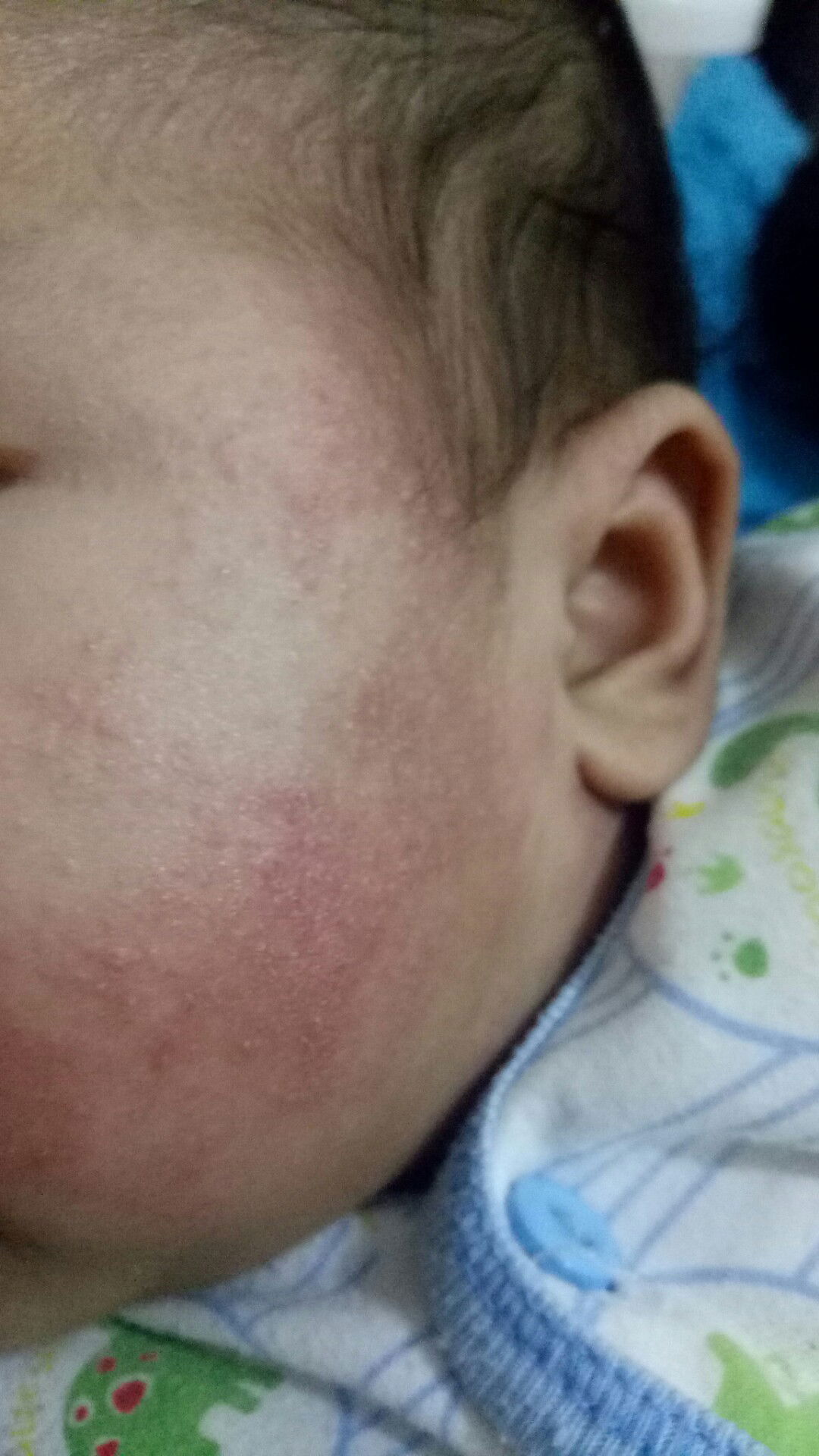 kemerahan pada pipi bayi