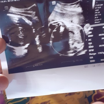 ap pnjelasan usg ni bunda aku gak gerti