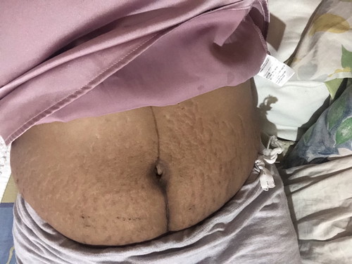 STRETCHMARKS