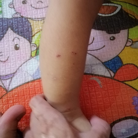 Anak selalu garu tangan dan kaki