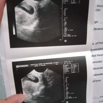 ULTRASOUND (9weeks 5 days)