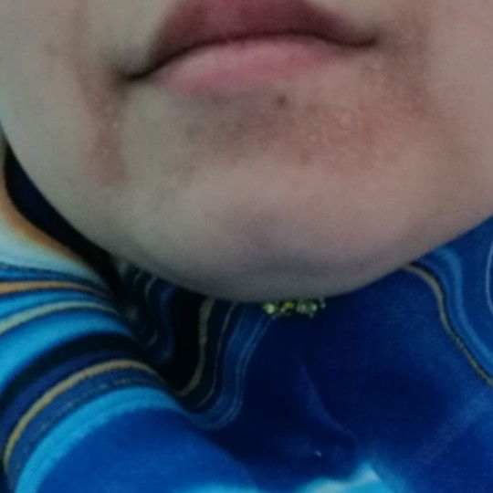 Alahan di muka ms pregg (low confident) ?