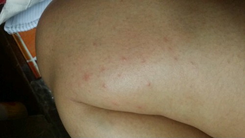 Rashes or Allergy