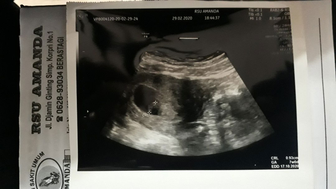 Hamil lagi setelah BO