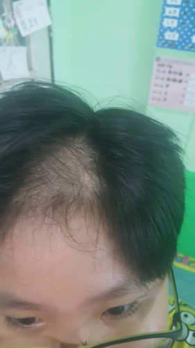 ลูกชายผมร่วงยันรากผม
