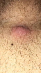 ingrown hair
